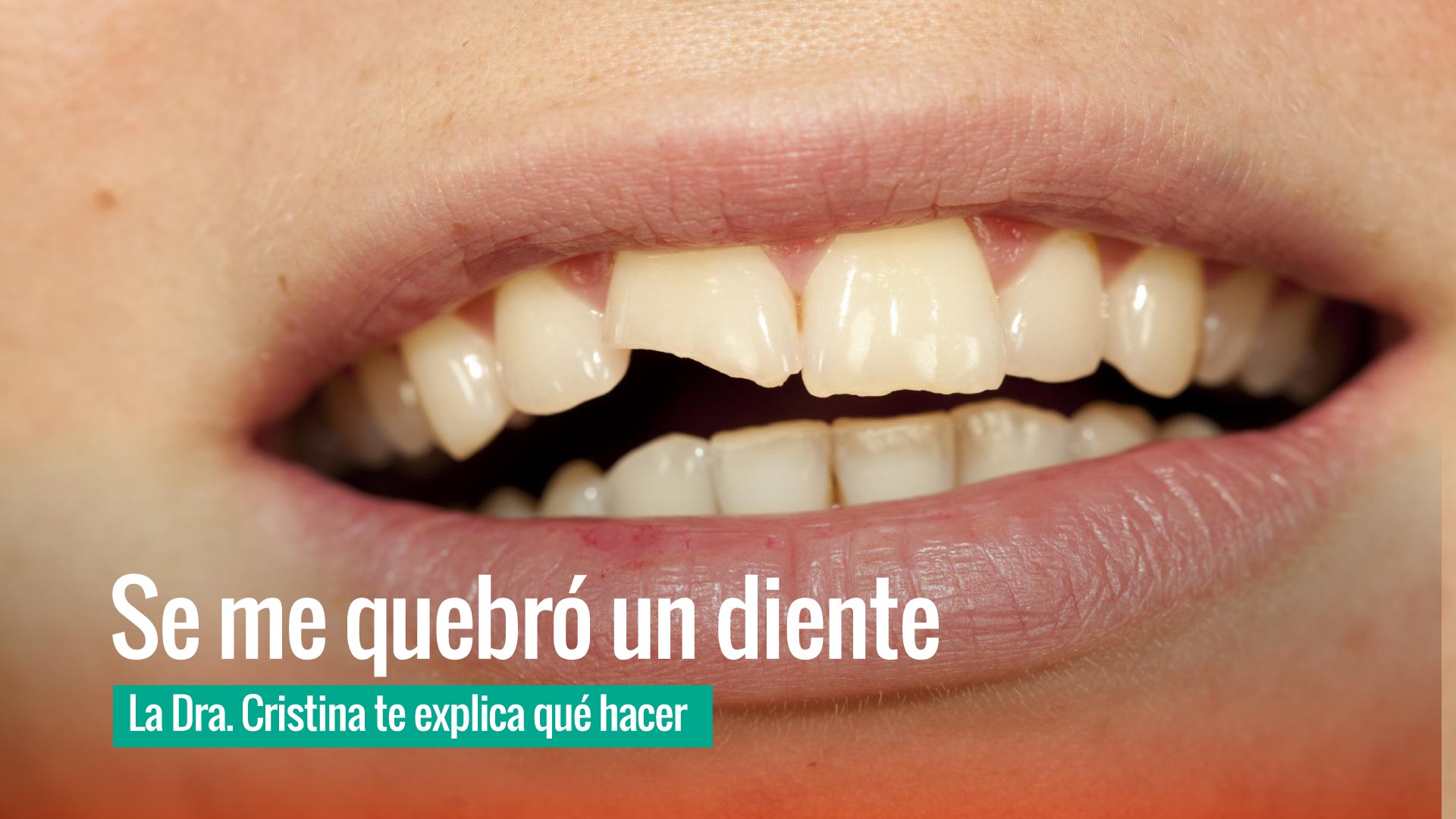 Diente frontal quebrado - qué hacer si se rompe un diente - Dra. Cristina López